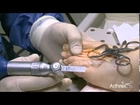 Surgical technique by Dr Belis: Plantar Plate Repair on Cadaver June 2013